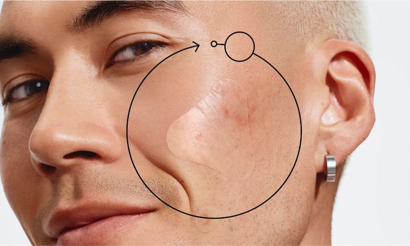 A close-up of a person's cheek with a clear Neutrogena® Sensitive Skin Triangle Acne Patch over a blemish.