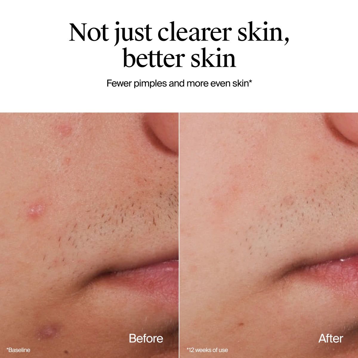 NA_US_NTG_AcneLegacy_OFAW_FF_9.1oz_ATF7_BeforeandAfter_Amazon_3000x3000.webp