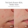 NA_US_NTG_AcneLegacy_OFAW_FF_9.1oz_ATF7_BeforeandAfter_Amazon_3000x3000.webp