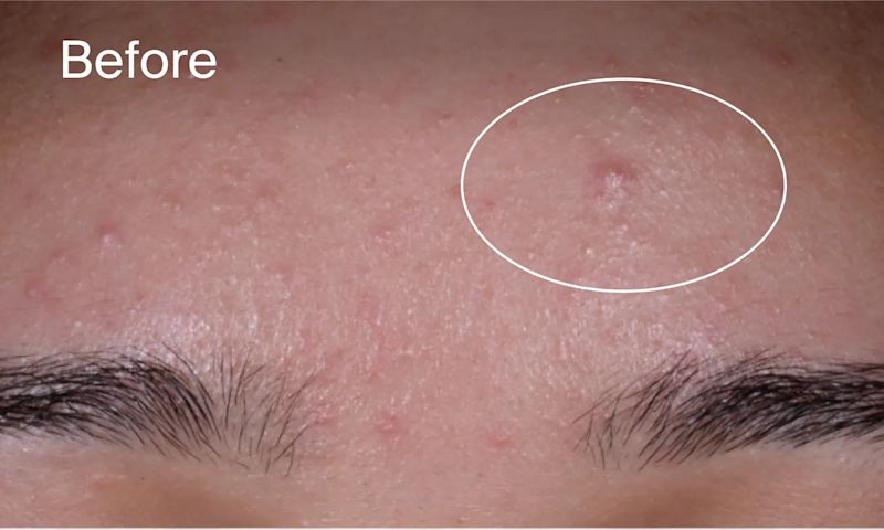 Before Image: Forehead with acne marks before applying Neutrogena® Evenly Clear™ Acne Exfoliant