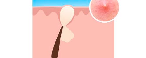 Acné: Descubre todo lo que deberías saber - Image 8 - Neutrogena - es-ES