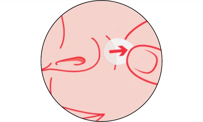 Remove patch. Peel off when patch turns with or 6-8 hours after application.