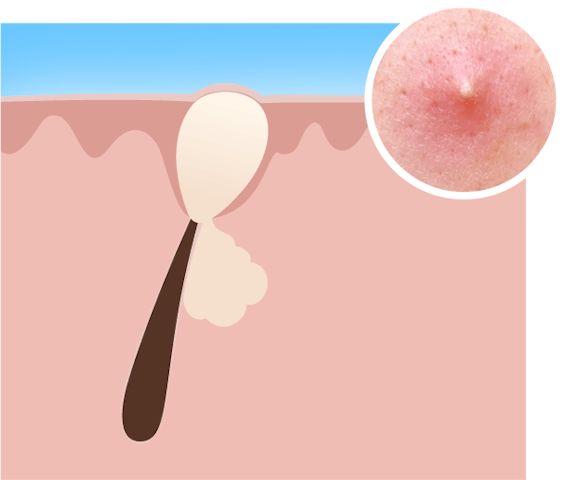 acne types whiteheads