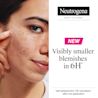 NTG EMEA UK 3574661889047 91005800 EMEA Neutrogena Sensitive Blemish Patch 30pc SI01 THUMB JPG