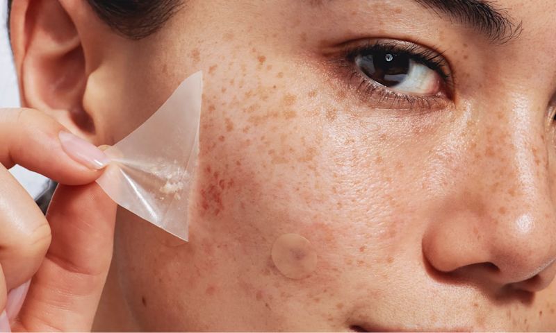 A close-up of a person's cheek as they peel off a clear Neutrogena Sensitive Skin Triangle acne patch.