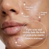 Image of woman with acne marks. Fight acne and visibly fade the look of post-acne marks suitable for all skin tones