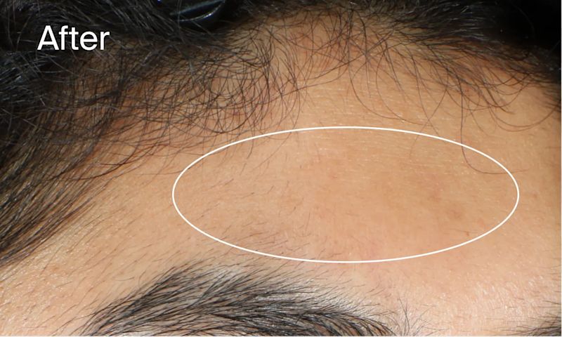 Results of using Neutrogena® Evenly Clear™ Acne Gel Moisturizer for 4 weeks