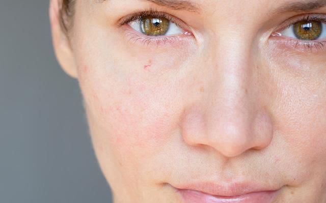 Mujer de piel lozana con manchas en su rostro 