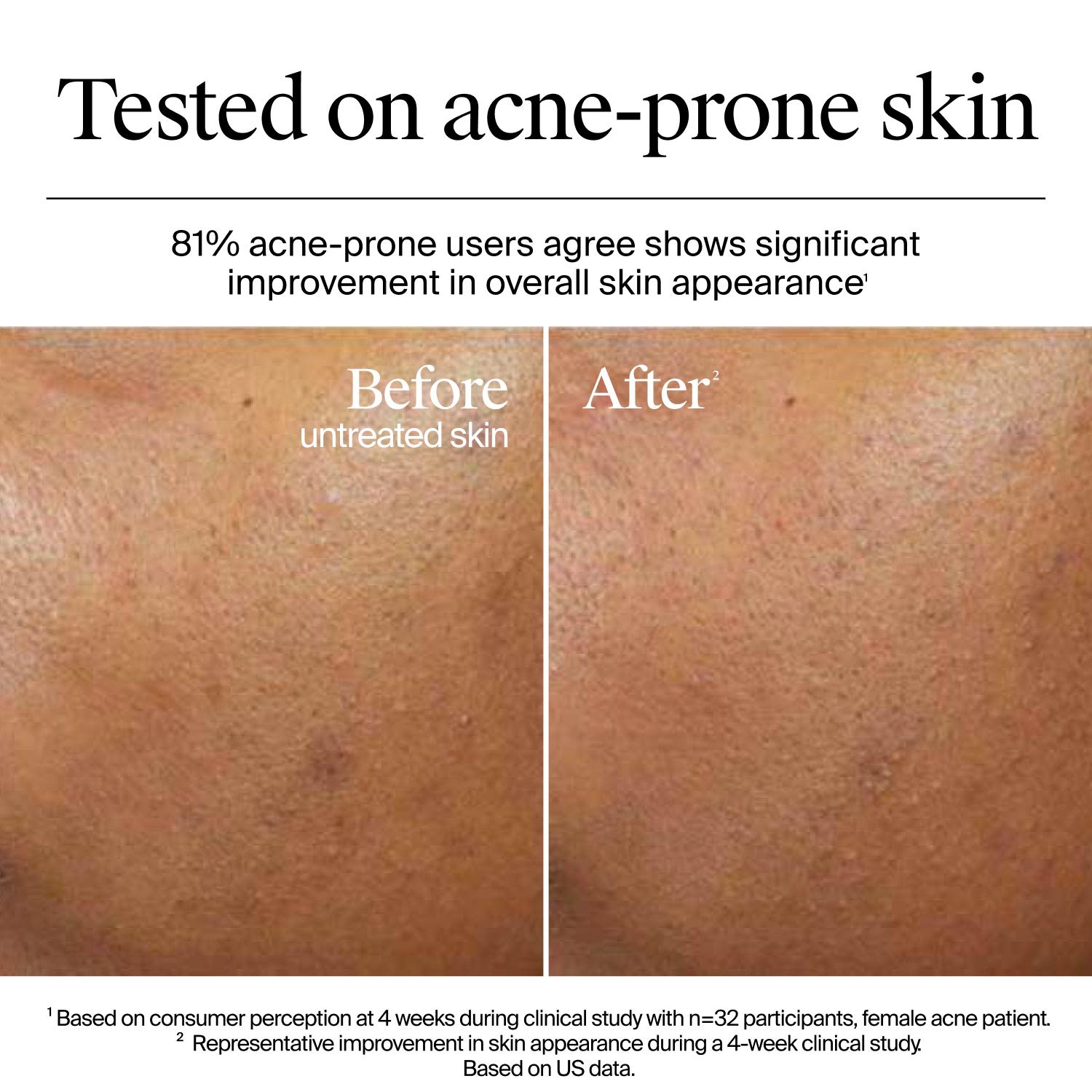 Résultats avant et après 4 semaines d’utilisation du gel-crème Neutrogena Hydro Boost sur une peau sujette à l’acné