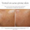 Résultats avant et après 4 semaines d’utilisation du gel-crème Neutrogena Hydro Boost sur une peau sujette à l’acné