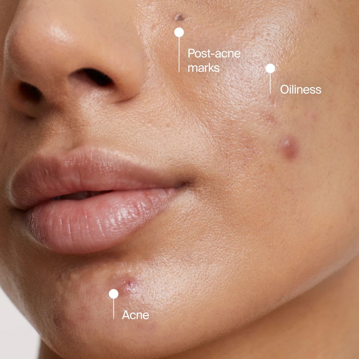 NA-US-NTG-Acne-CleansingMask-InsightsAcne-ATF3-Amazon-3000x3000.webp