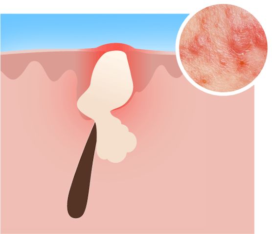 acne types papules