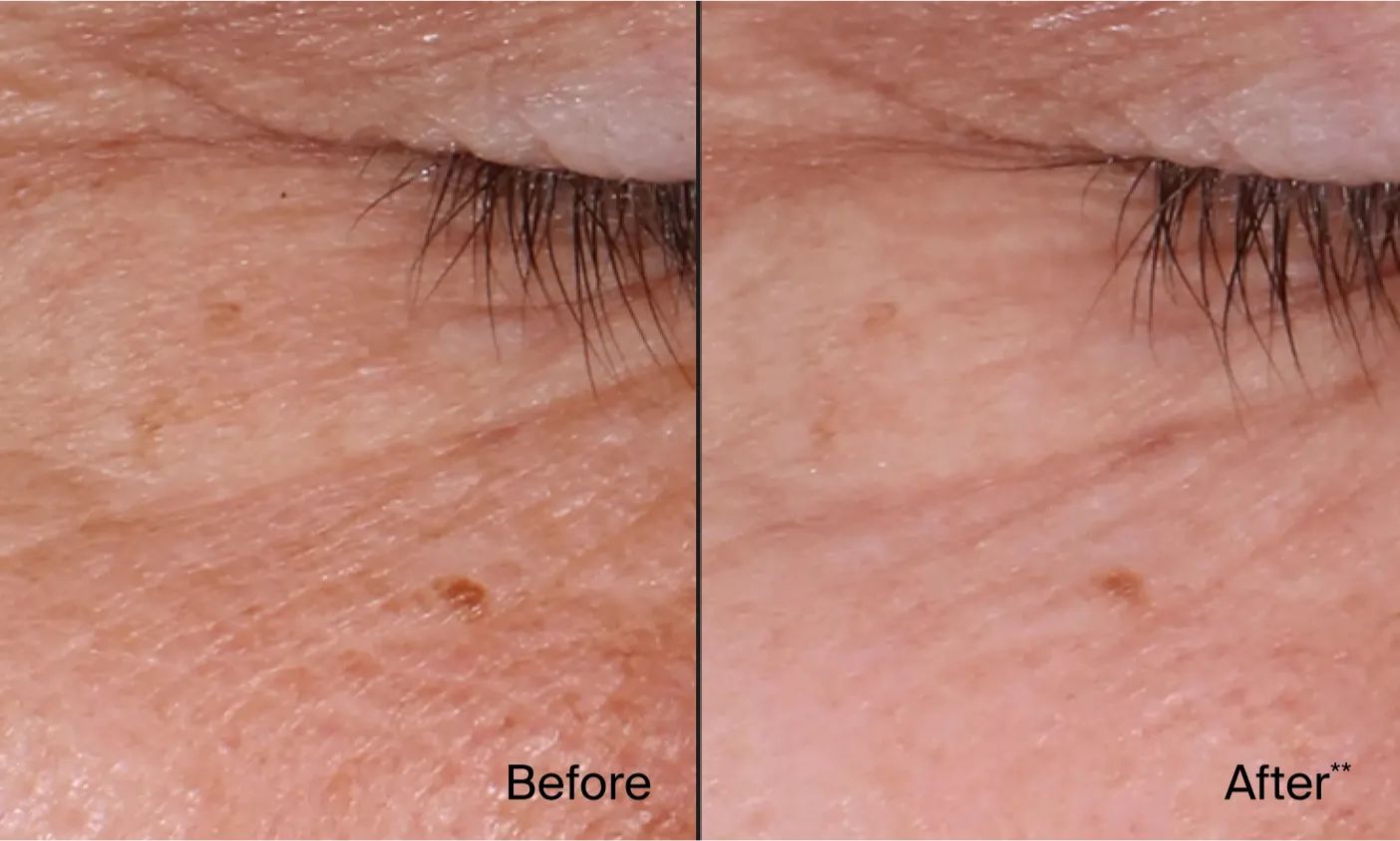 Image comparing before and after of using Neutrogena® Rapid Wrinkle Repair® products
