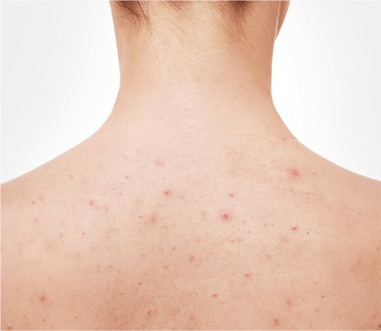 acne types back acne