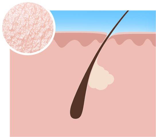 acne types comedones