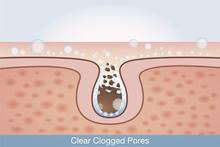 what_can_you_do_to_treat_acne_breakouts_640x427_resize