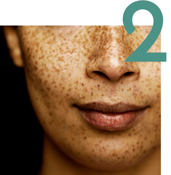 Bas du visage d'une personne ayant des taches de rousseur avec le chiffre 2 dans le coin