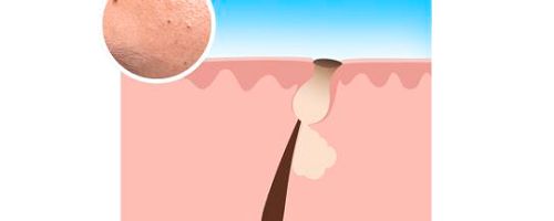 Acné: Descubre todo lo que deberías saber - Image 9 - Neutrogena - es-ES