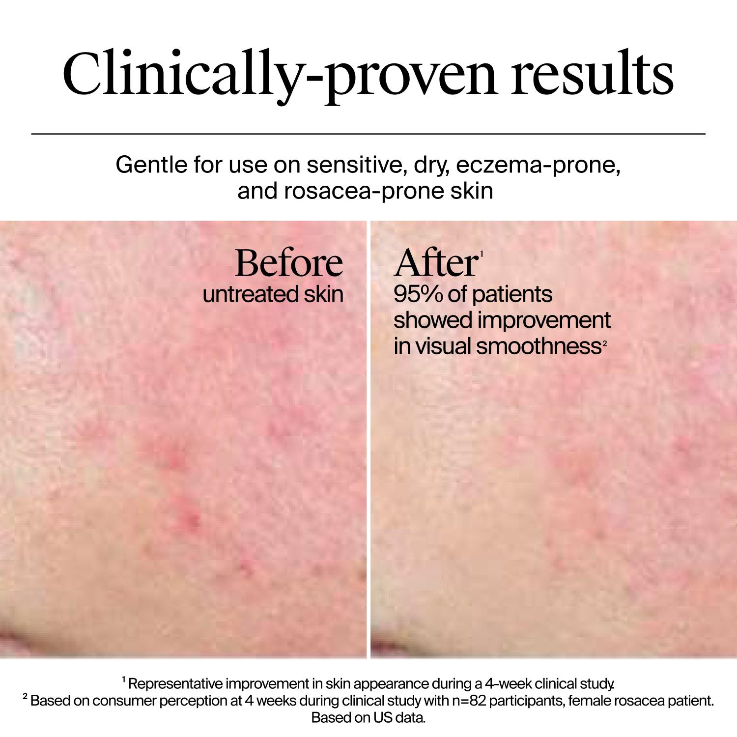 Before and after 4-week use of Neutrogena Hydro Boost Gel Cream on sensitive, dry, eczema, and rosacea-prone skin