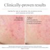 Before and after 4-week use of Neutrogena Hydro Boost Gel Cream on sensitive, dry, eczema, and rosacea-prone skin