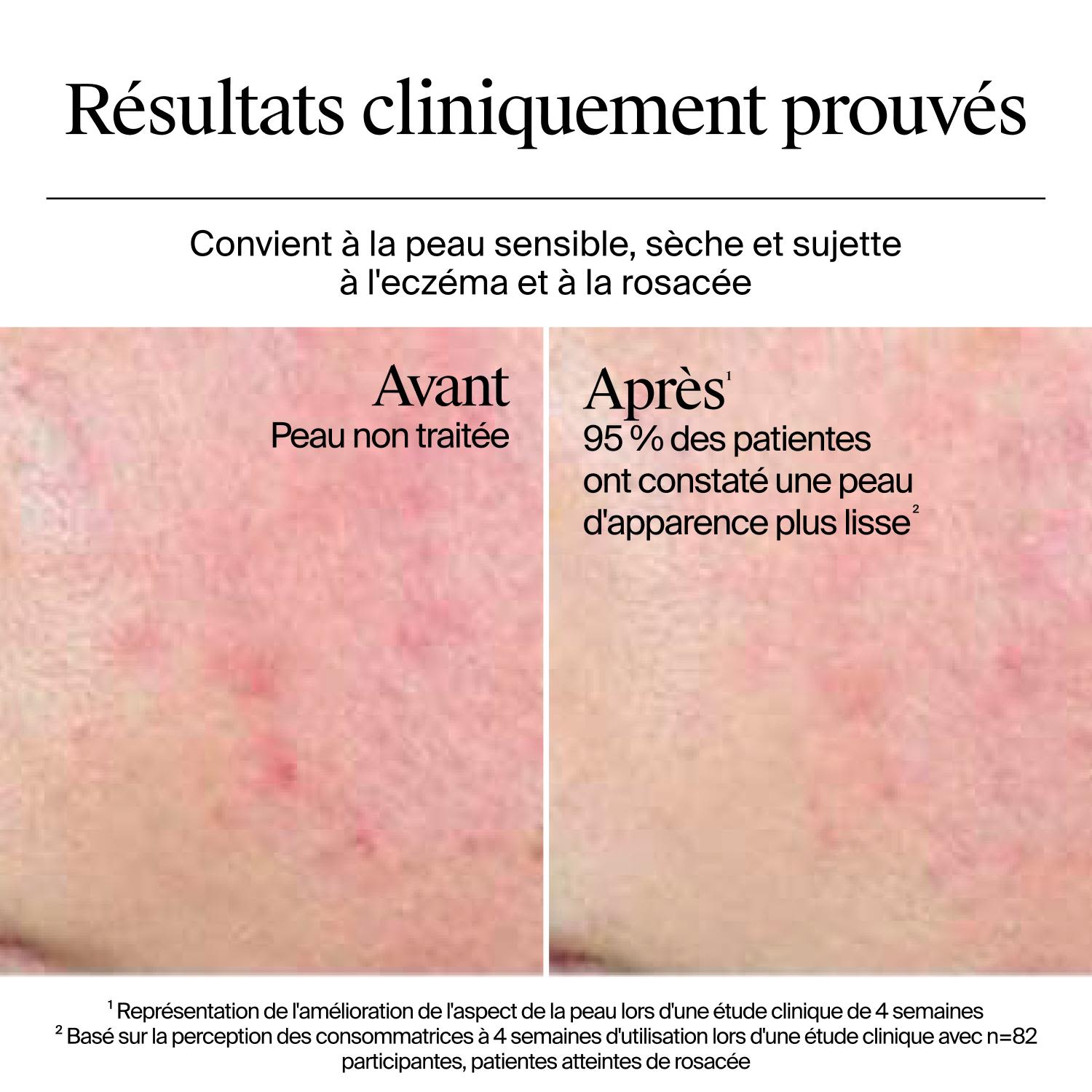 Résultats avant et après 4 semaines d’utilisation du gel-crème Neutrogena Hydro Boost sur une peau sensible, sèche, sujette à l’eczéma et à la rosacée