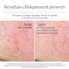 Résultats avant et après 4 semaines d’utilisation du gel-crème Neutrogena Hydro Boost sur une peau sensible, sèche, sujette à l’eczéma et à la rosacée