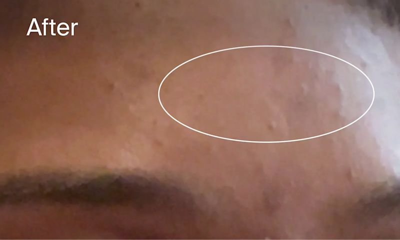 After Image Forehead clear of acne marks after applying Neutrogena® Evenly Clear™ Facial Retinoid for 2 weeks