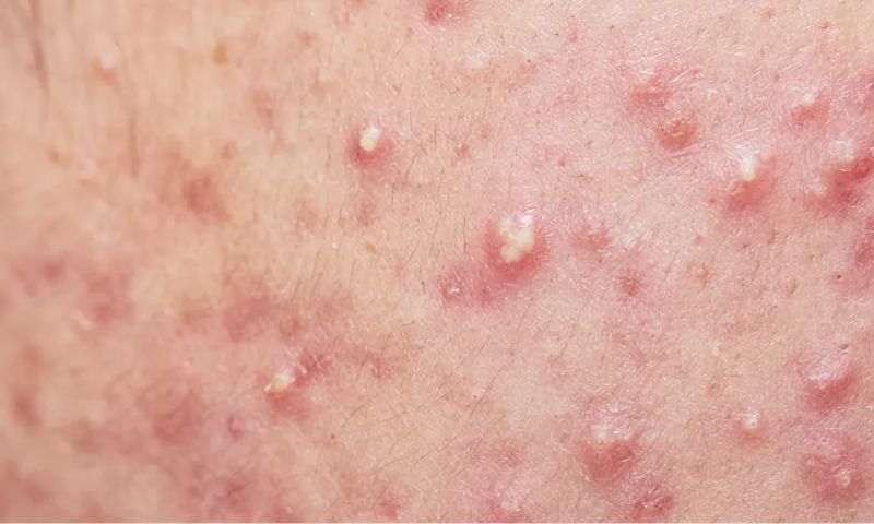 example of nodules and cysts on skin