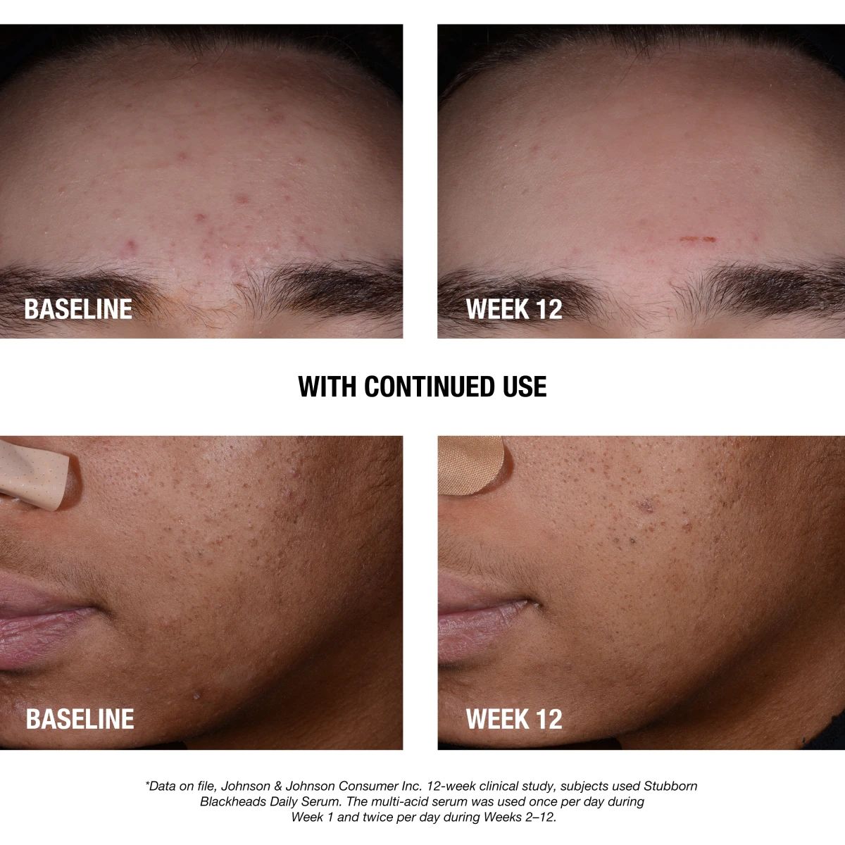 NTG_StubbornAcne_BlackheadSerum_Claim_text.webp