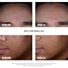 NTG_StubbornAcne_BlackheadSerum_Claim_text.webp