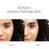 Achieve clearer-looking skin. Image displays woman clear of acne before and after using Neutrogena® Rapid Clear Stubborn Acne Spot Gel