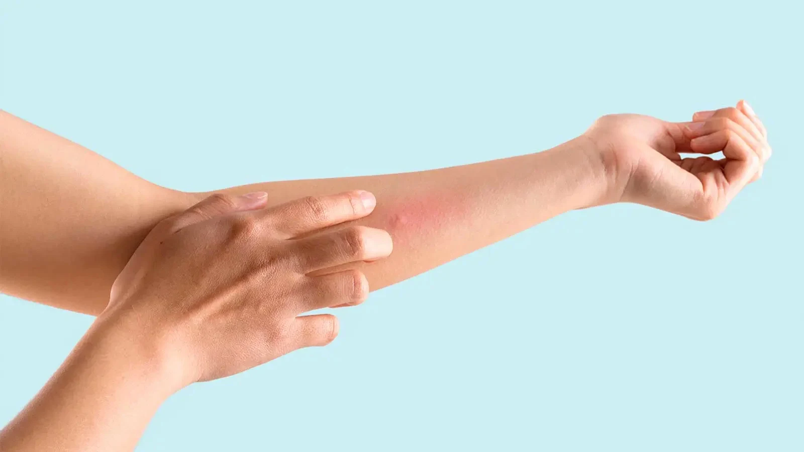 En hand med irriterad hud