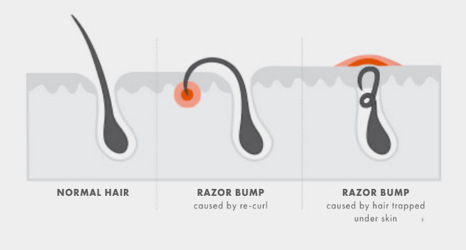 Tips for minimising razor bumps while shaving