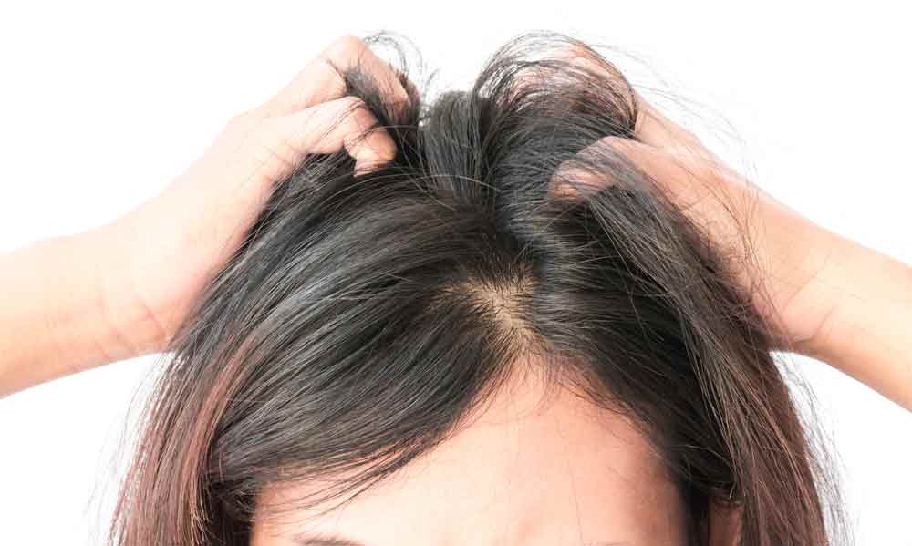 Itch & Dandruff Cause Hair Fall Image Title:Itching results in thin hair