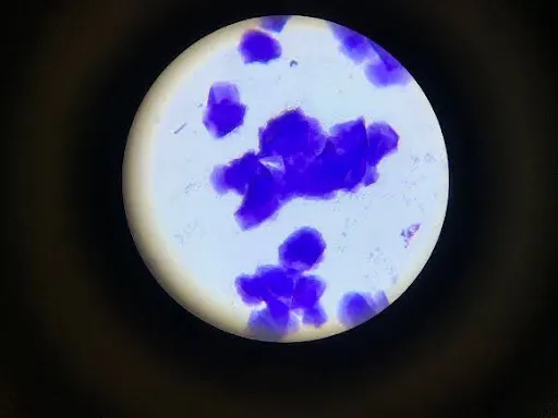 Vaginal cytology slide showing clumped angled cells with no nuclei.