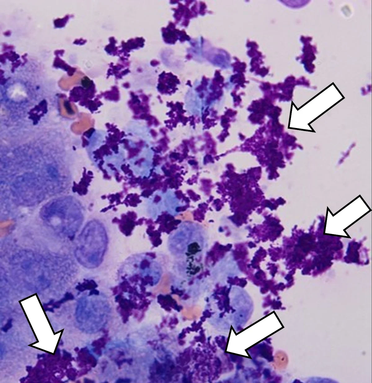 A stained cytology image showing pale purple cells with clumps of dark purple amorphous material.