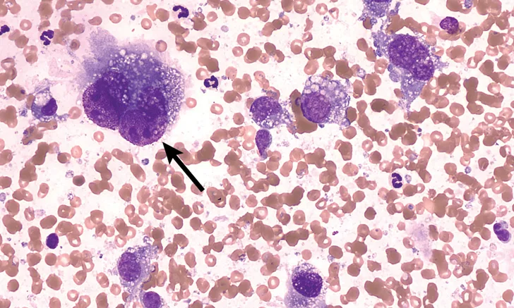 Several irregularly sized and shaped basophilic cells with foamy cytoplasm surrounded by RBCs.