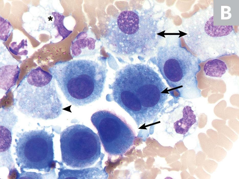 Effusion Cytology | Clinician's Brief