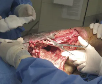 managing-degloving-shearing-injuries-step-by-step-guide