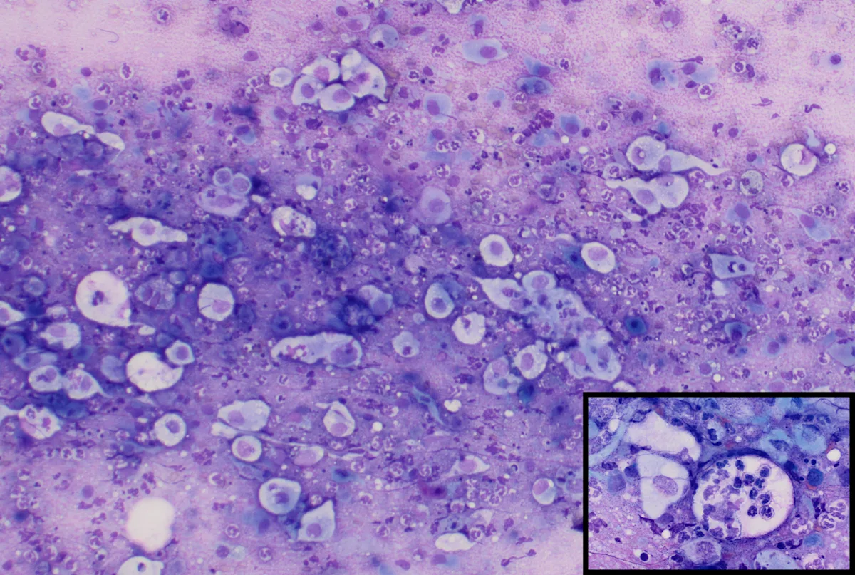 Multiple pale-blue, variably shaped cells with light-purple–staining nuclei and an inset showing neutrophils within a cell.
