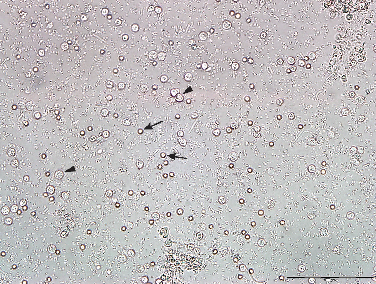 Cytology slide showing numerous small and slightly larger round cells against a clear background.