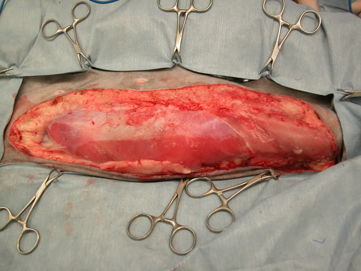 Before and after surgical images of unilateral radical mastectomy with removal of multiple tissue layers.