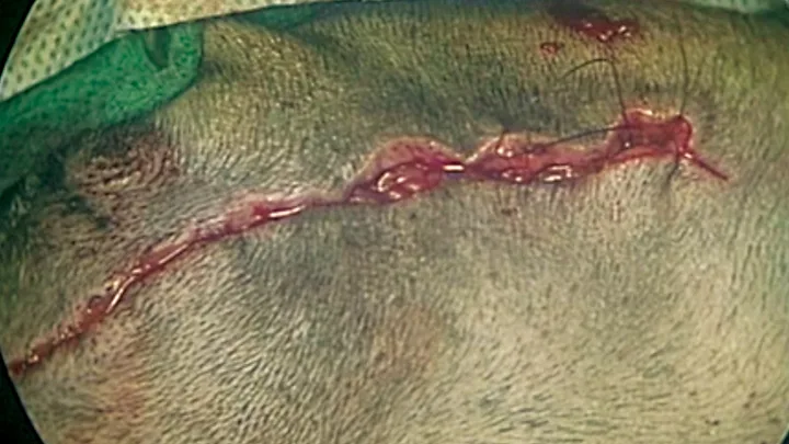Close up of incised skin during final closure of subcutaneous layer.