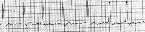 ECG tracing with sporadically irregular QRS complexes and fibrillation waves.