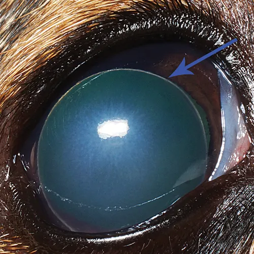 Round blue colored structure with thin white border seen anterior to iris obscuring most intraocular structures.
