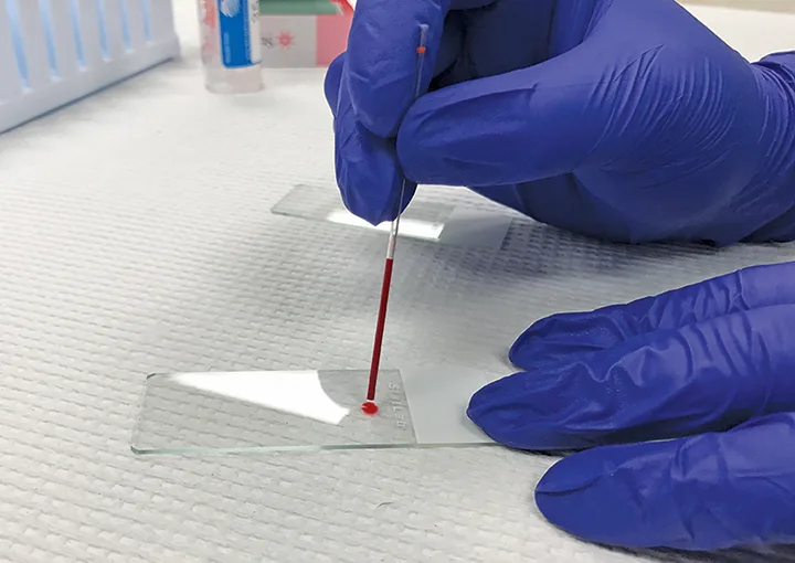 Gloved hands holding down glass slide while dripping blood onto slide from hematocrit tube.