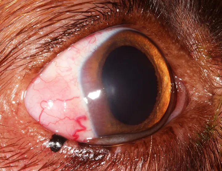 Diffusely pink-tinged region with irregular border encroaching from later aspect of scleral toward cornea.