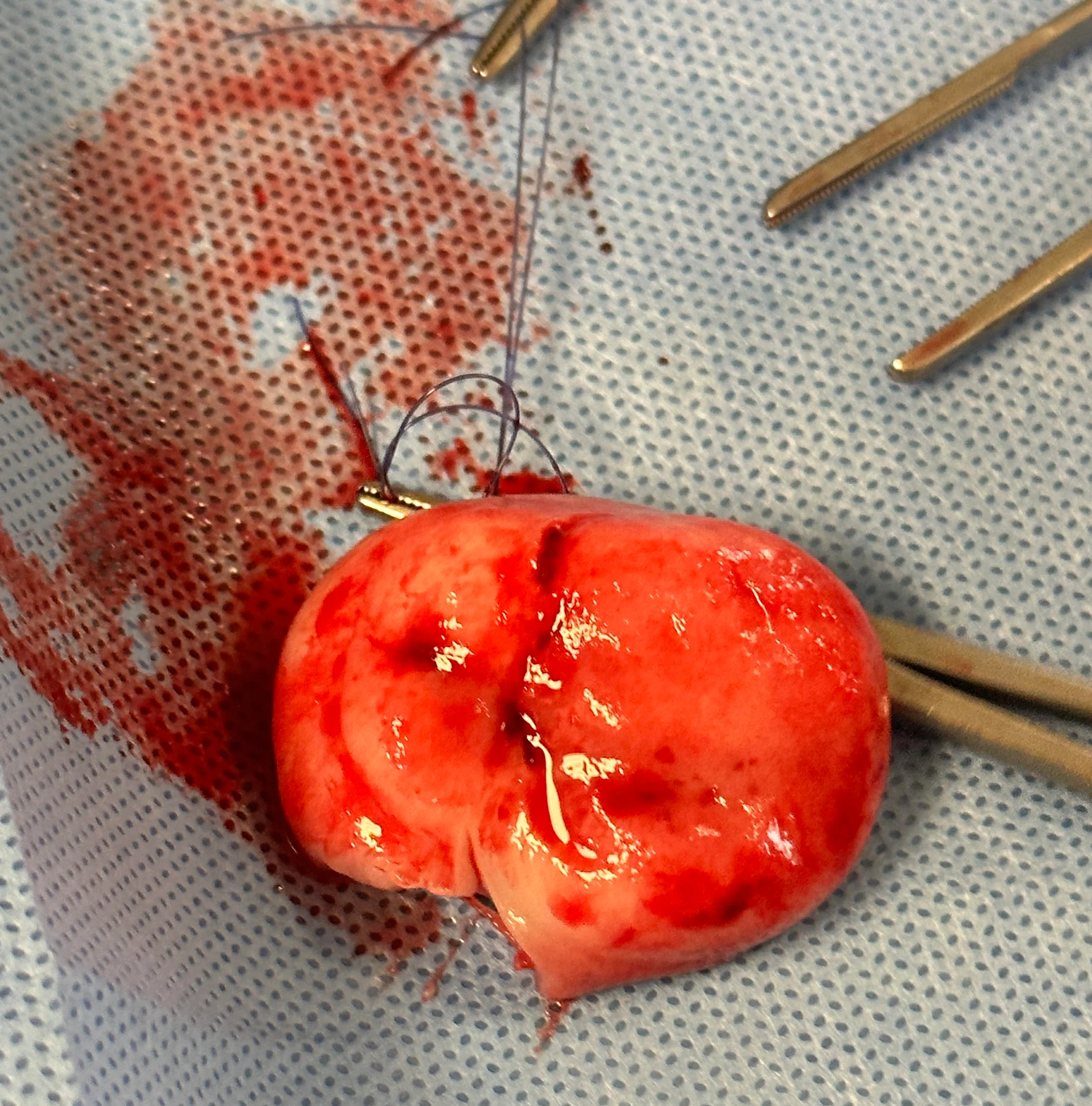 Figure 2A: An intraoperative photo of a feline patient with an irregular mass on the urinary bladder. Figure 2B: An excised urinary bladder mass sits on a surgical drape. 