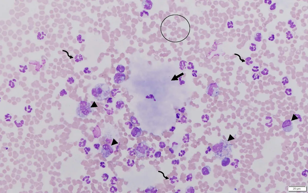 Second microscope image of peritoneal fluid from the patient.