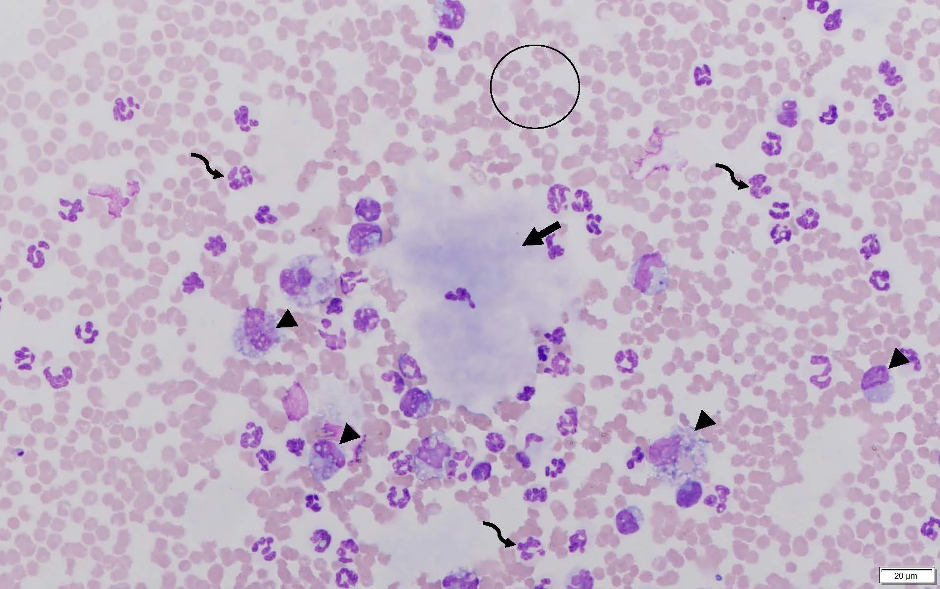 Second microscope image of peritoneal fluid from the patient.